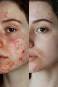 Discover how energy-based devices and tailored skincare reduce acne, scarring, and pigmentation for effective UK treatment outcomes.